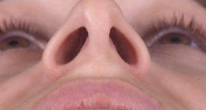 Obstrucción nasal