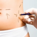 Liposuccion por ultrasonidos